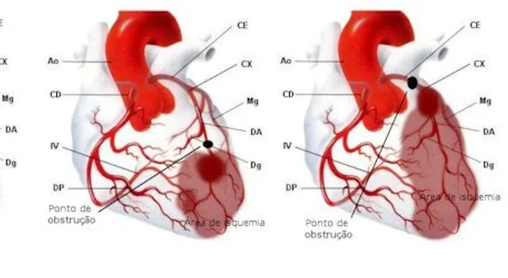 ¿Por qué ocurre un infarto fulminante? 