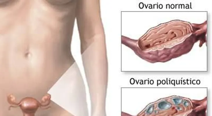¿Son los ovarios poliquísticos los causantes de la pérdida de mi embarazo?