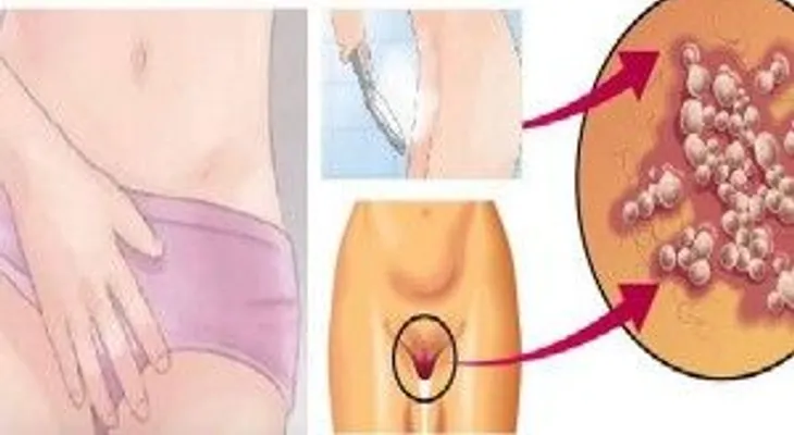 Enrojecimiento y picazon en tu vagina: Signos que nunca debes ignorar