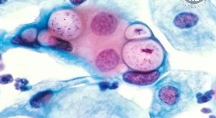 ¿Sabes lo que es la clamidiasis?