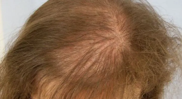 Alopecia: Perdida del cabello anormal que no distingue sexo