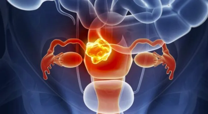 Cáncer de cuello uterino amenaza la vida de las venezolanas