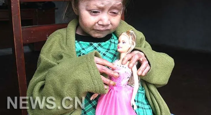 Niña de 9 años no envejece por rara enfermedad