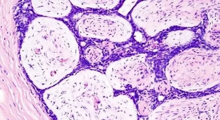  Descubren más de 70 variantes genéticas que elevan riesgo de cáncer de mama 