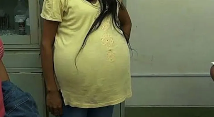 Extraen un tumor de 16 kilos a una mujer en Perú