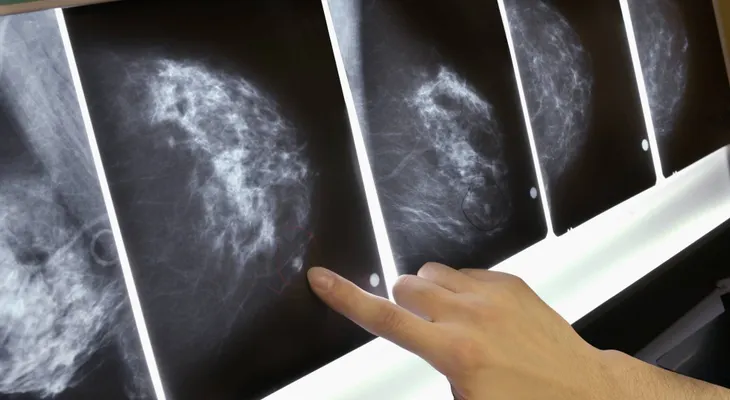 En un avance sin precedente en el mundo, un equipo de EE.UU logra eliminar un tumor a una paciente con metástasis