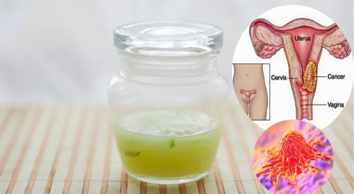 Cómo sanar cancer de utero con estos 3 ingredientes de gran alcance