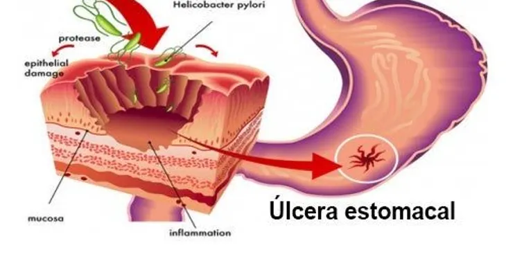 5 remedios efectivos para eliminar el Helicobacter Pylori 