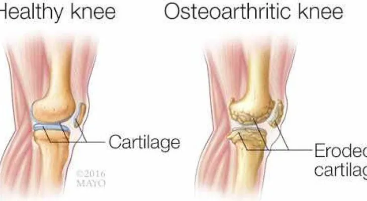 Salud: Tratamiento de la osteoporosis