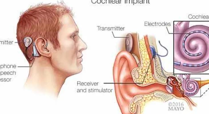 Los implantes cocleares pueden ser una alternativa 