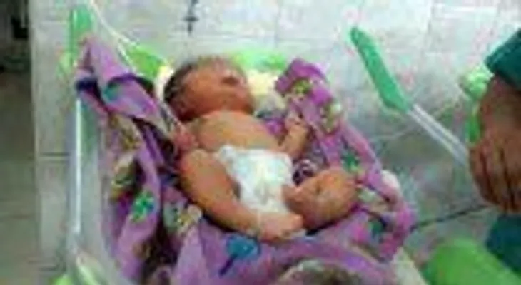 Trasladan a Lima niño peruano que nació con dos narices