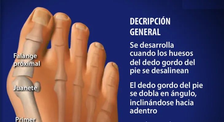 8 excelentes pasos que no FALLAN para quitar juanetes en los pies