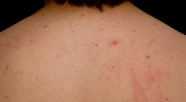 Cómo quitar el acné del cuello y la espalda