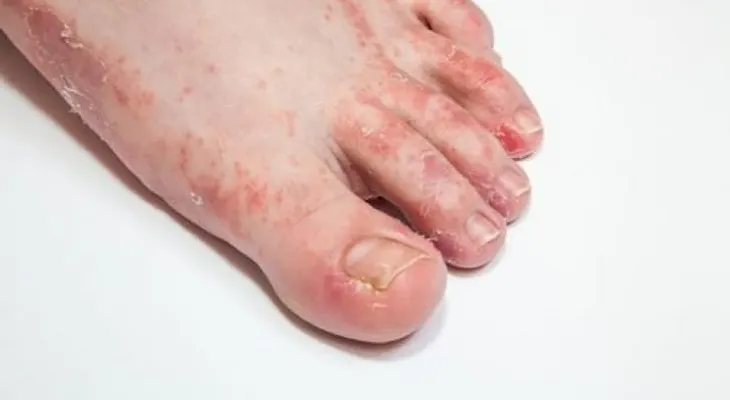 ¿Hongos en los pies? ¡3 remedios para eliminarlos definitivamente!