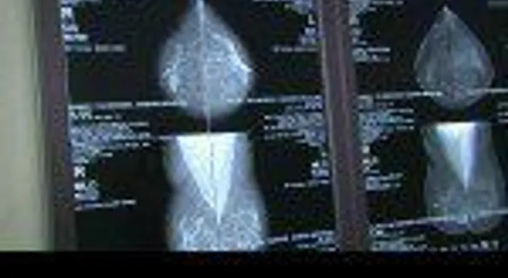 Unas 500 mil mujeres sufren de cáncer de mama en RD ¿Qué hacer para prevenirlo? (VIDEO)