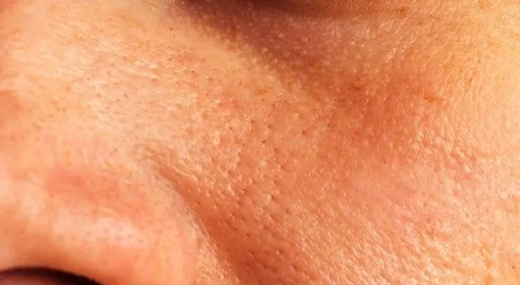 5 soluciones naturales para reducir los poros dilatados de la piel