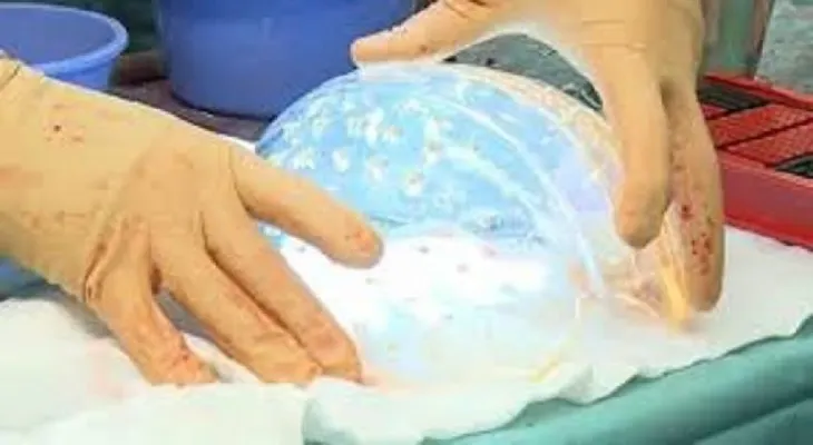 Trasplantan un cráneo impreso en 3D a una niña con hidrocefalia