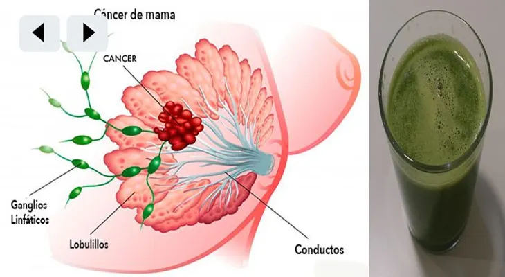 En la lucha contra el cáncer este es el único jugo que destruye el cáncer de mama