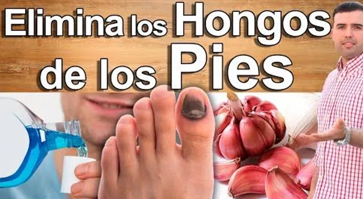Remedio que no falla para eliminar los hongos