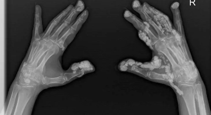 "Mi cuerpo se está convirtiendo en piedra", la terrible historia de Virdee, quien era profesora en Inglaterra         