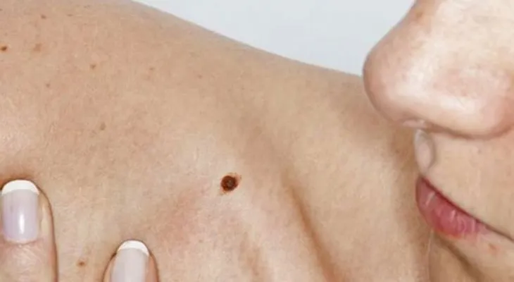 Cómo reconocer el cáncer de piel ? Esto podría salvar tu vida!