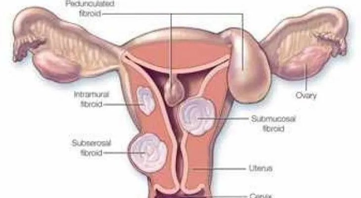 Explorar las alternativas de tratamiento de las mujeres con fibromas