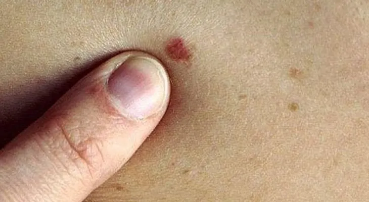 6 señales para identificar el cáncer en la piel