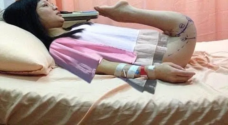 Una mujer con una extraña enfermedad que le permite doblar sus piernas 