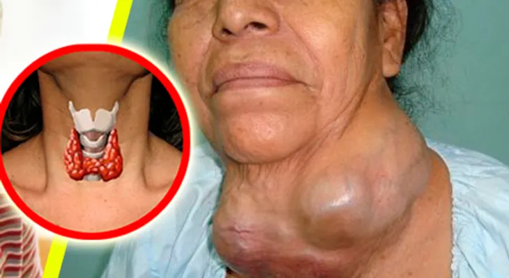 La cura de la tiroides la tienes en tu casa y los doctores nos la ocultan