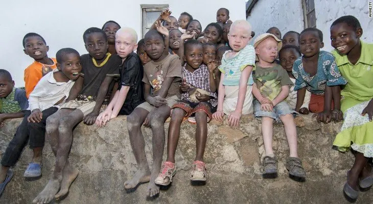 Caza de seres humanos: niños albinos de Malawi son asesinatos para vender sus huesos