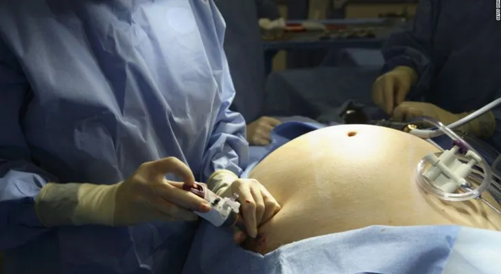 ¿Debe ser obligatoria la terapia para pacientes que se someten a cirugía de pérdida de peso?