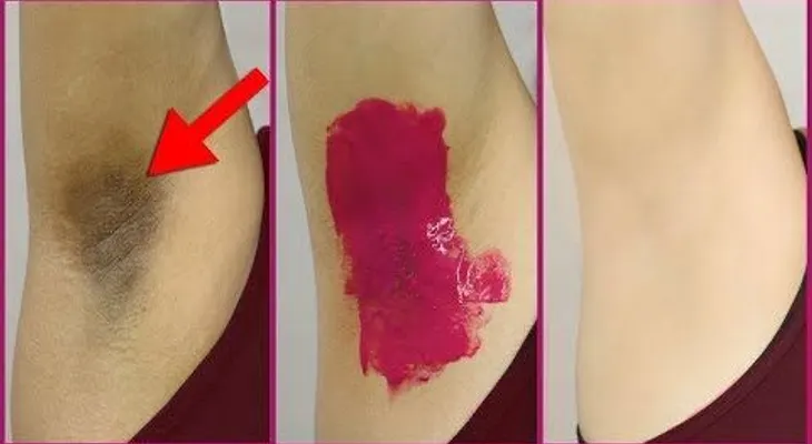 Por qué no me lo dijeron antes: blanquea tus axilas en 10 minutos con este simple remedio
