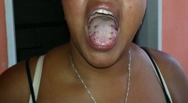 Le implantaron un parche en la lengua para que no puedas tragar