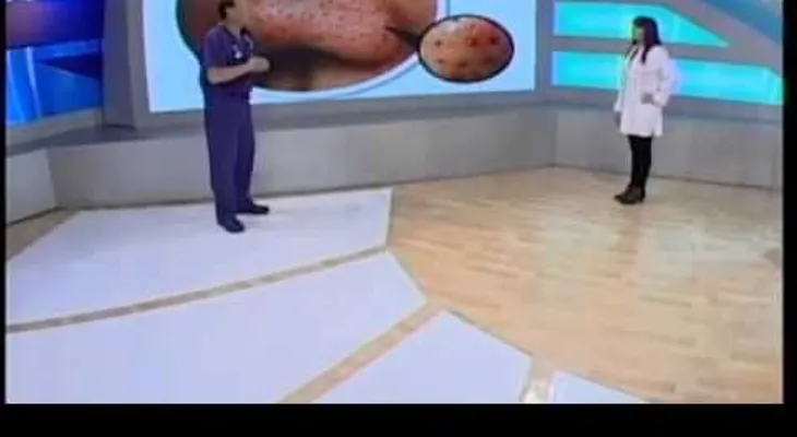 Las espinillas pueden poner en riesgo nuestra salud