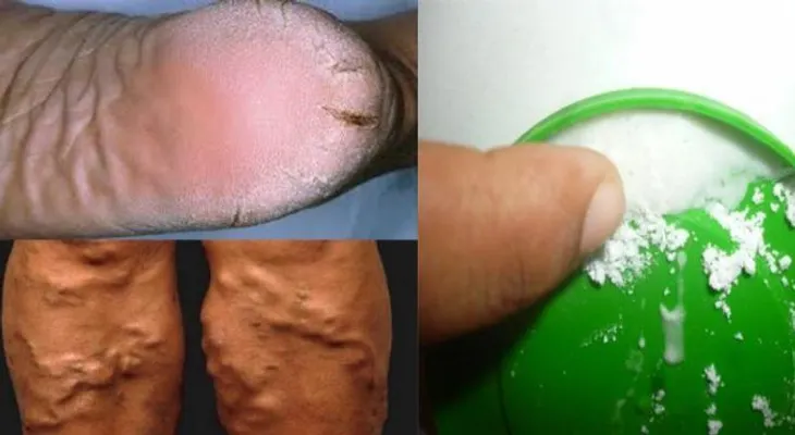 En 10 días, este remedio te cura los talones agrietados callos y venas varicosas 