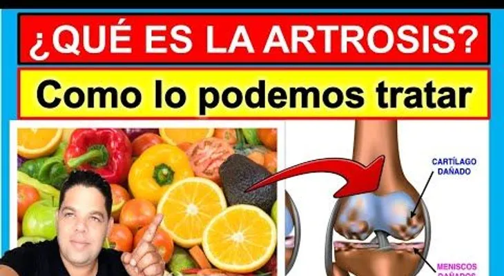 Cómo tratar efectivamente la artrosis