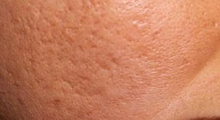  3 Remedios naturales para las cicatrices del acné 
