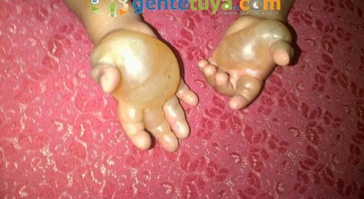 Acusan a una mujer de quemarle las manos a su hijo de cuatro años