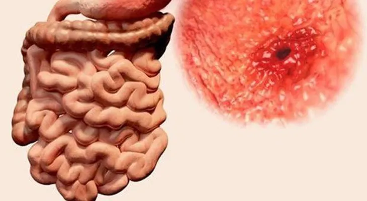 ¿La gastritis puede causar cáncer de estómago?. Por qué aparece y qué relación tienen