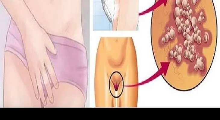5 Remedios preparado en la casa que eliminan para SIEMPRE los hongos vaginales