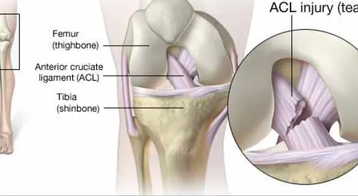 Algunas actividades aumentan el riesgo para lesiones en el ligamento cruzado anterior
