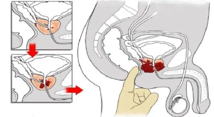 Como el jengibre destruye la próstata, el cáncer de colon y de ovario. Es mejor que la quimioterapia !!