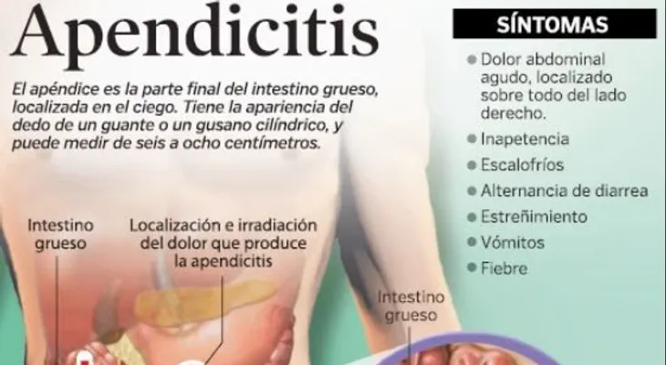 Apendicitis; causas, síntomas y tratamiento