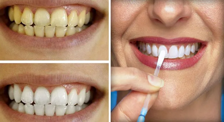 Los dentistas ocultan esto. El método más rápido y eficaz para blanquear dientes