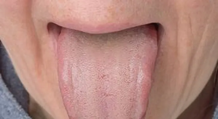 Los mejores remedios para tratar la lengua blanca