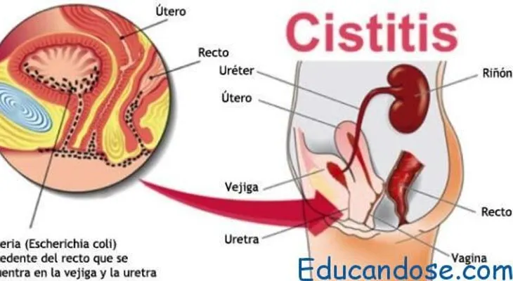 8 remedios para curar la cistitis