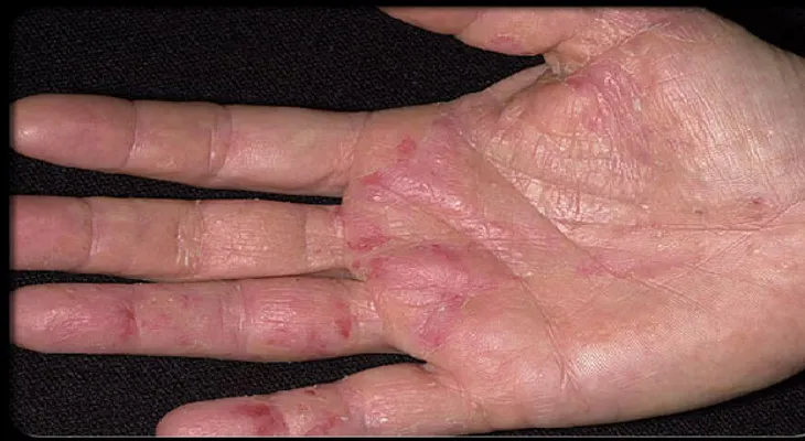 Tus manos pueden advertir sobre síntomas de cáncer, ¡no los ignore!