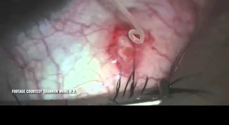 Los médicos le sacan algo asqueroso a este hombre (VIDEO