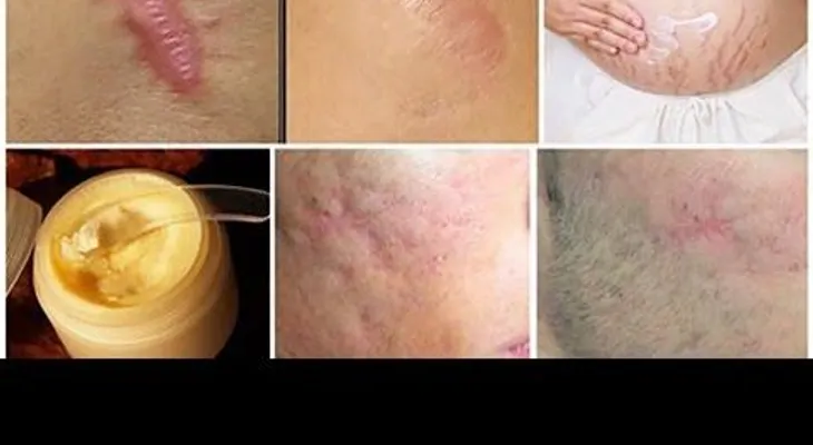 Cómo quitar las estrías en pocos días  IMPRESIONANTE!  (VIDEO)